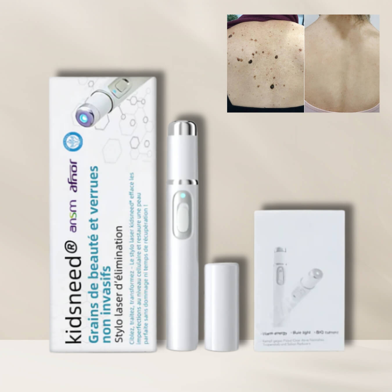 Kidsneed – Penna Laser Non Invasiva per la Rimozione di Nei e Verruche